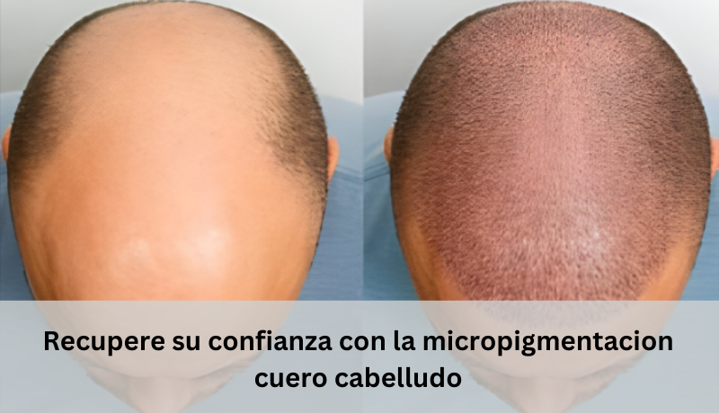 micropigmentacion cuero cabelludo